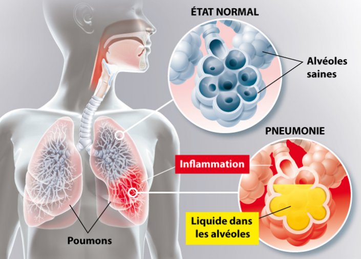 Un schéma de l'inflammaion du poumon avec de l'eau dans les alvéoles